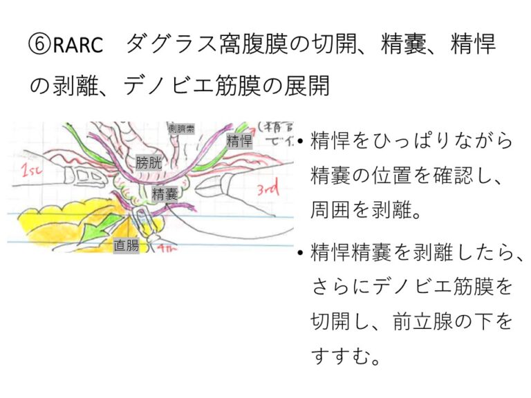 ロボット支援腹腔鏡下膀胱全摘除（RARC)+回腸導管造設術 – 泌尿器科医 澤田のブログ